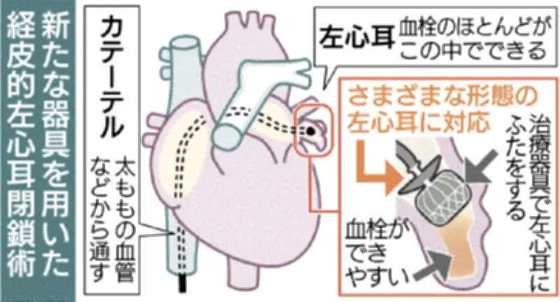 琉大病院不整脈センター、新器具で左心耳閉鎖術 脳梗塞予防に期待