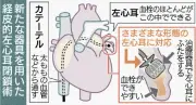 琉大病院不整脈センター、新器具で左心耳閉鎖術 脳梗塞予防に期待